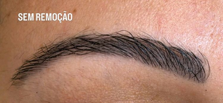 Sobrancelha antes da remoção a laser