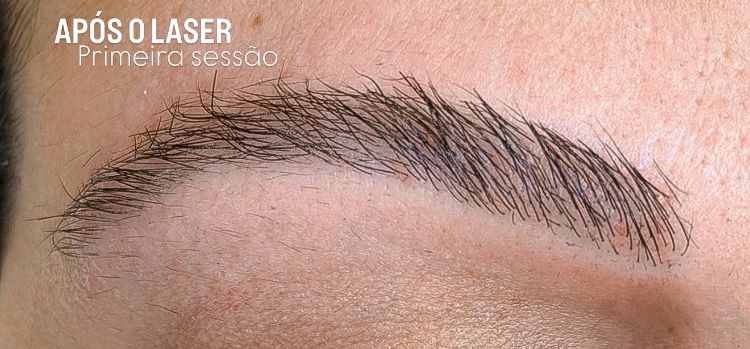 Sobrancelha após a primeira sessão de laser