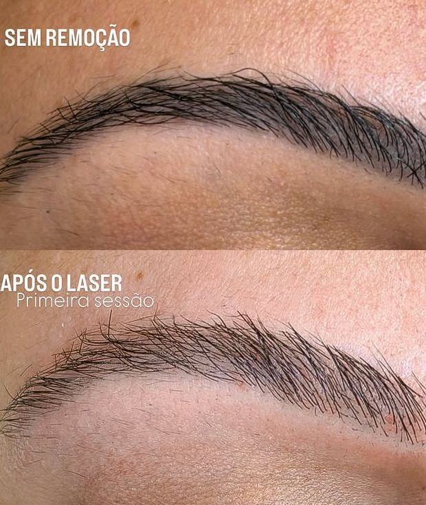 Resultado da remoção a laser