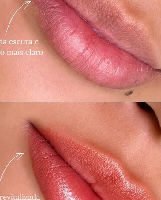 Revitalização labial antes e depois